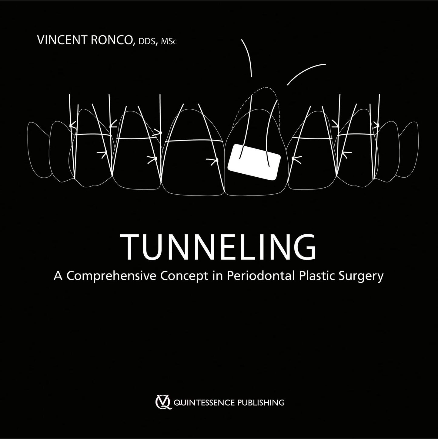 Tunneling: A Comprehensive Concept in Periodontal Plastic Surgery